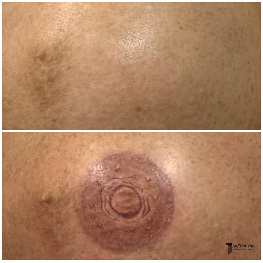 bore and after softap 3d areola tattoo restoration with hand method pigments and needles