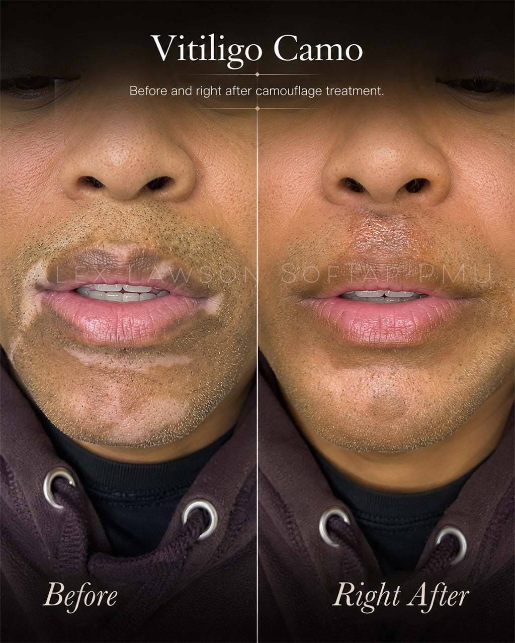 Before and after comparison of softap permanent makeup vitiligo camouflage treatment on a man's face.
