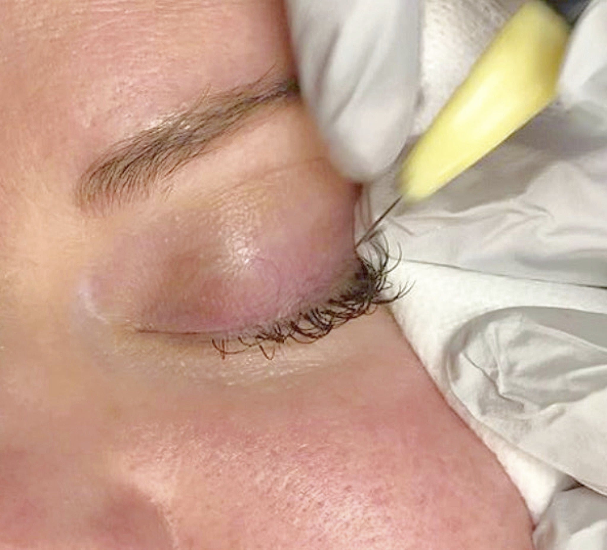 Close up of closed eye with SofTap 10 prong permanent makeup hand method needle hovering before implantation