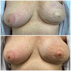 A before-and-after side-by-side comparison of a woman's chest area showing breast surgery re-pigmentation results. The top image shows breasts without pigment, and the bottom image shows breasts with applied softap tattoos.